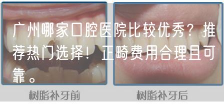广州哪家口腔医院比较优秀？推荐热门选择！正畸费用合理且可靠。