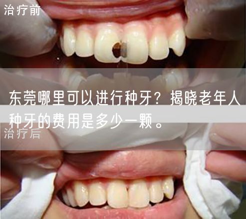 东莞哪里可以进行种牙？揭晓老年人种牙的费用是多少一颗。
