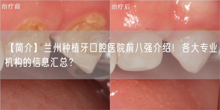 【简介】兰州种植牙口腔医院前八强介绍！各大专业机构的信息汇总？