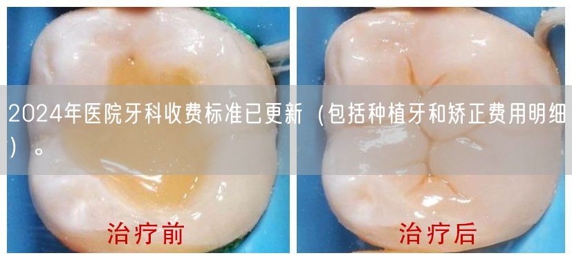 2024年医院牙科收费标准已更新（包括种植牙和矫正费用明细）。