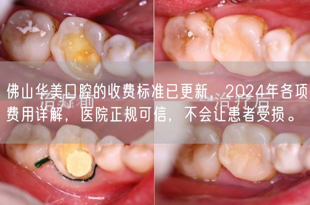 佛山华美口腔的收费标准已更新，2024年各项费用详解，医院正规可信，不会让患者受损。