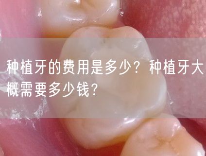 种植牙的费用是多少？种植牙大概需要多少钱？
