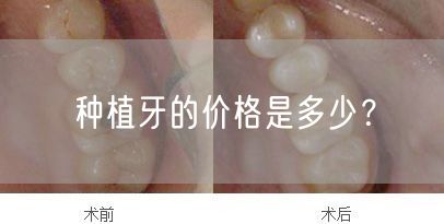 种植牙的价格是多少？