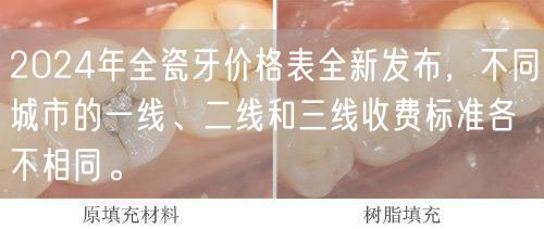 2024年全瓷牙价格表全新发布，不同城市的一线、二线和三线收费标准各不相同。