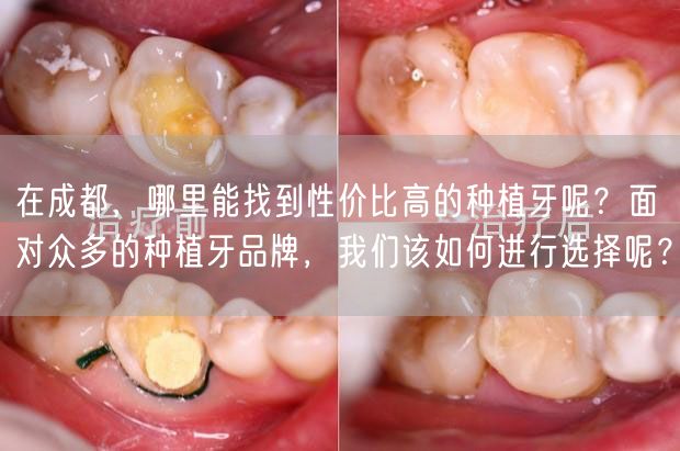在成都，哪里能找到性价比高的种植牙呢？面对众多的种植牙品牌，我们该如何进行选择呢？