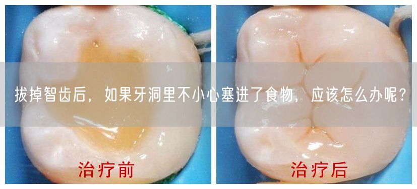 拔掉智齿后，如果牙洞里不小心塞进了食物，应该怎么办呢？