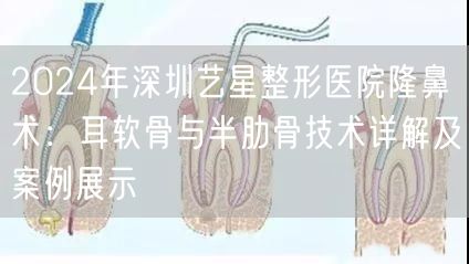 2024年深圳艺星整形医院隆鼻术：耳软骨与半肋骨技术详解及案例展示