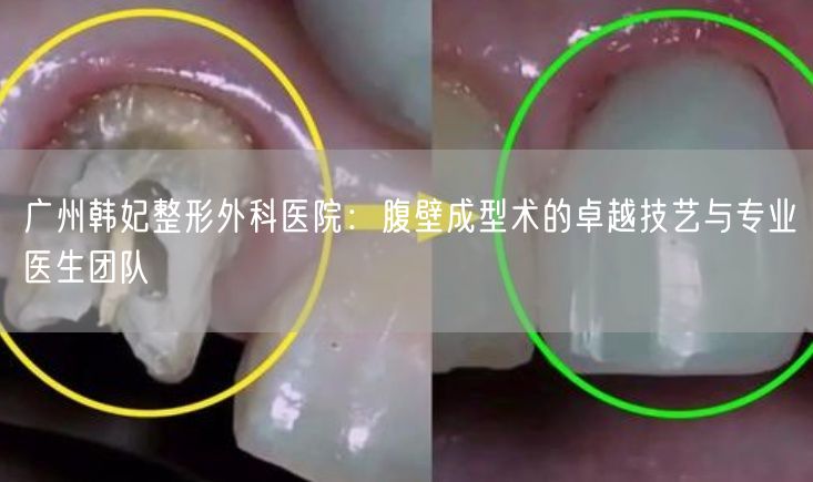 广州韩妃整形外科医院：腹壁成型术的卓越技艺与专业医生团队
