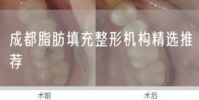 成都脂肪填充整形机构精选推荐