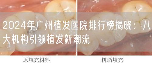 2024年广州植发医院排行榜揭晓：八大机构引领植发新潮流