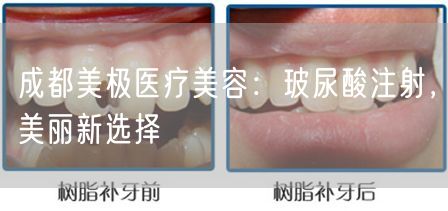 成都美极医疗美容：玻尿酸注射，美丽新选择