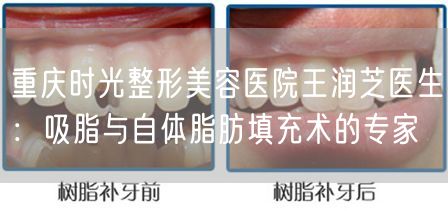 重庆时光整形美容医院王润芝医生：吸脂与自体脂肪填充术的专家