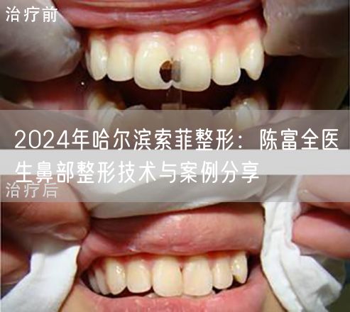 2024年哈尔滨索菲整形：陈富全医生鼻部整形技术与案例分享