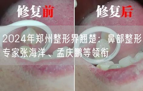 2024年郑州整形界翘楚：鼻部整形专家张海洋、孟庆鹏等领衔