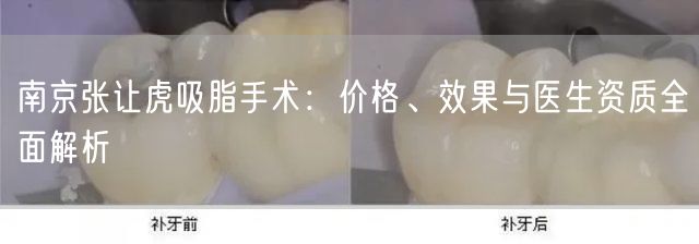 南京张让虎吸脂手术：价格、效果与医生资质全面解析
