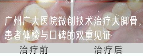 广州广大医院微创技术治疗大脚骨，患者体验与口碑的双重见证