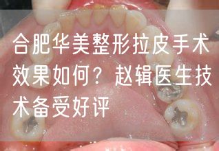 合肥华美整形拉皮手术效果如何？赵辑医生技术备受好评