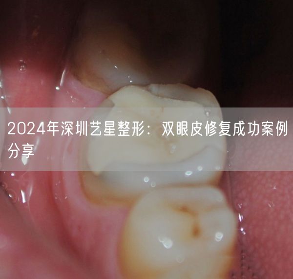 2024年深圳艺星整形：双眼皮修复成功案例分享