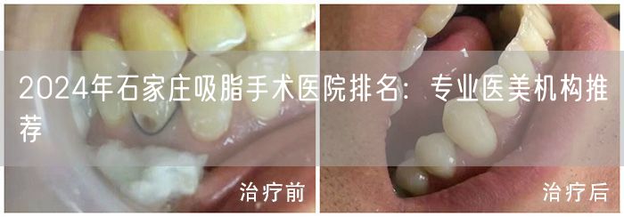 2024年石家庄吸脂手术医院排名：专业医美机构推荐