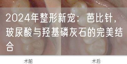 2024年整形新宠：芭比针，玻尿酸与羟基磷灰石的完美结合