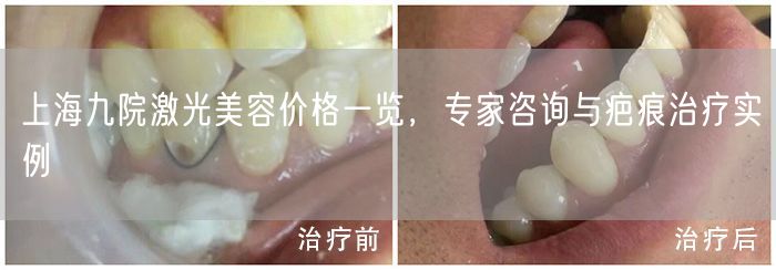 上海九院激光美容价格一览，专家咨询与疤痕治疗实例