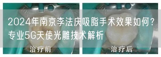 2024年南京李法庆吸脂手术效果如何？专业5G天使光雕技术解析