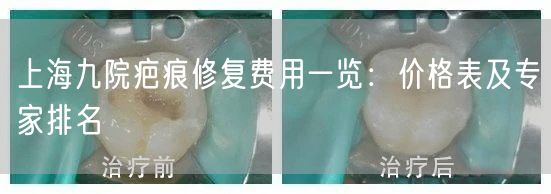 上海九院疤痕修复费用一览：价格表及专家排名