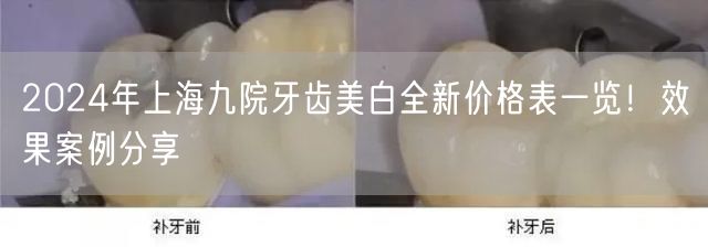 2024年上海九院牙齿美白全新价格表一览！效果案例分享