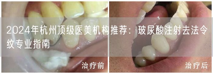 2024年杭州顶级医美机构推荐：玻尿酸注射去法令纹专业指南