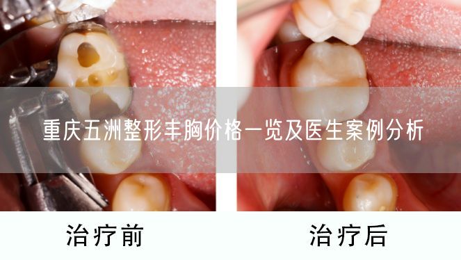 重庆五洲整形丰胸价格一览及医生案例分析