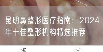 昆明鼻整形医疗指南：2024年十佳整形机构精选推荐