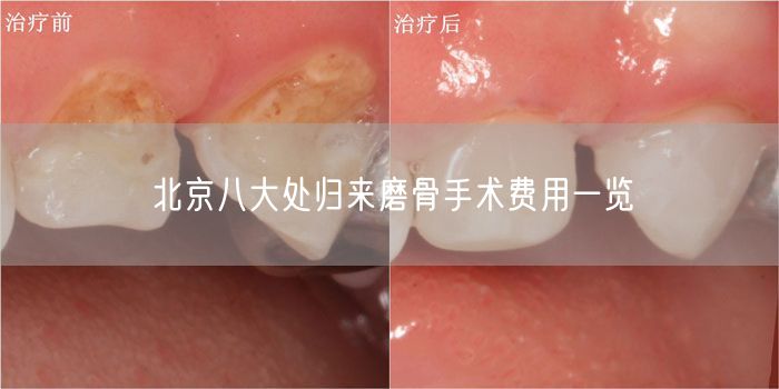 北京八大处归来磨骨手术费用一览