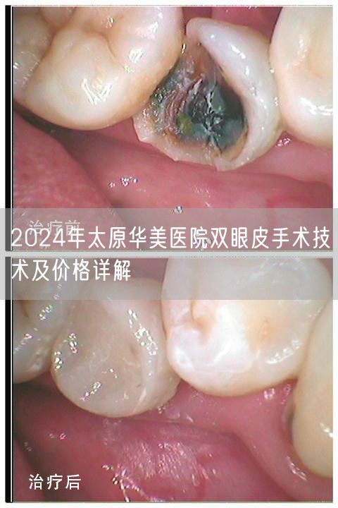 2024年太原华美医院双眼皮手术技术及价格详解