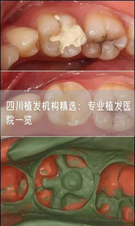 四川植发机构精选：专业植发医院一览