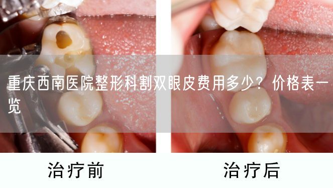 重庆西南医院整形科割双眼皮费用多少？价格表一览