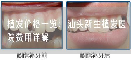 植发价格一览：汕头新生植发医院费用详解