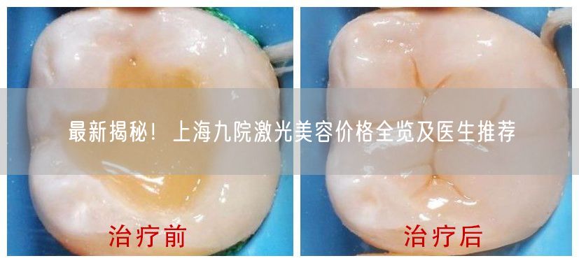 最新揭秘！上海九院激光美容价格全览及医生推荐
