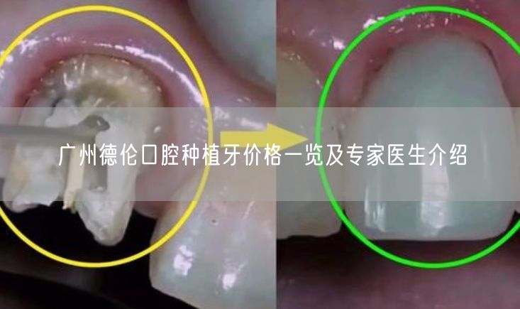 广州德伦口腔种植牙价格一览及专家医生介绍