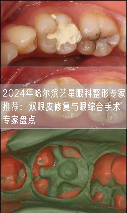 2024年哈尔滨艺星眼科整形专家推荐：双眼皮修复与眼综合手术专家盘点
