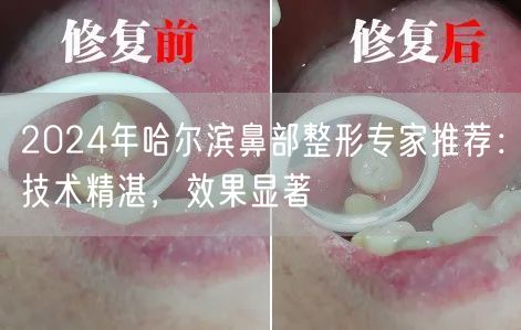 2024年哈尔滨鼻部整形专家推荐：技术精湛，效果显著