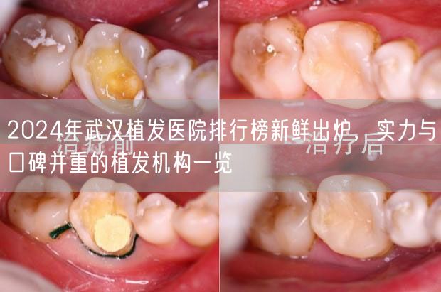2024年武汉植发医院排行榜新鲜出炉，实力与口碑并重的植发机构一览