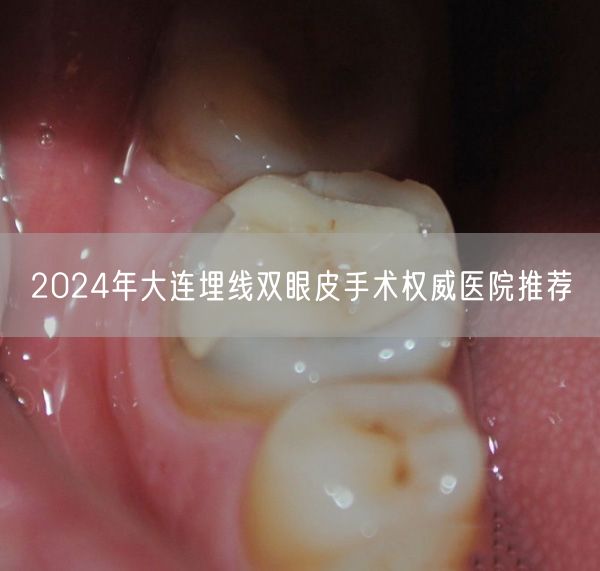 2024年大连埋线双眼皮手术权威医院推荐