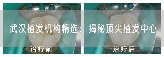 武汉植发机构精选：揭秘顶尖植发中心