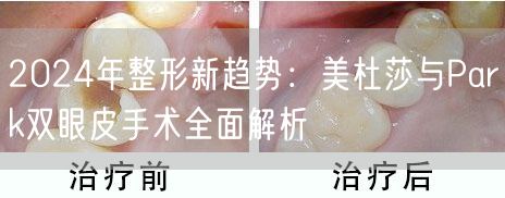 2024年整形新趋势：美杜莎与Park双眼皮手术全面解析