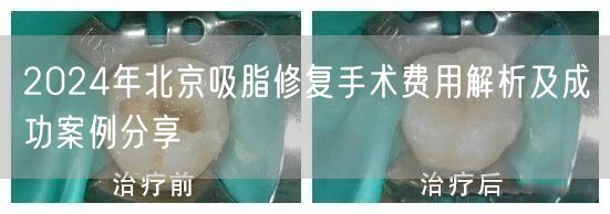 2024年北京吸脂修复手术费用解析及成功案例分享