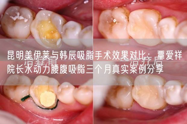 昆明美伊莱与韩辰吸脂手术效果对比：覃爱祥院长水动力腰腹吸脂三个月真实案例分享