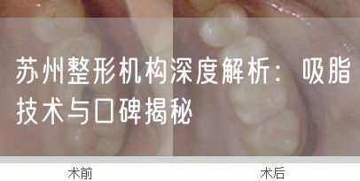 苏州整形机构深度解析：吸脂技术与口碑揭秘