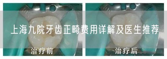 上海九院牙齿正畸费用详解及医生推荐