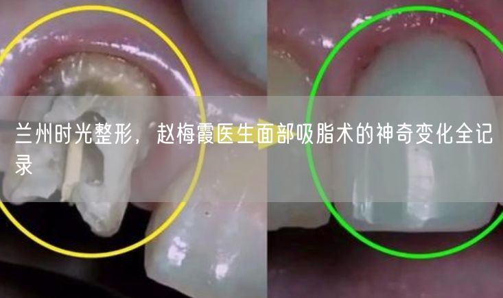兰州时光整形，赵梅霞医生面部吸脂术的神奇变化全记录