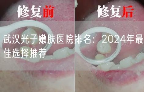 武汉光子嫩肤医院排名：2024年最佳选择推荐